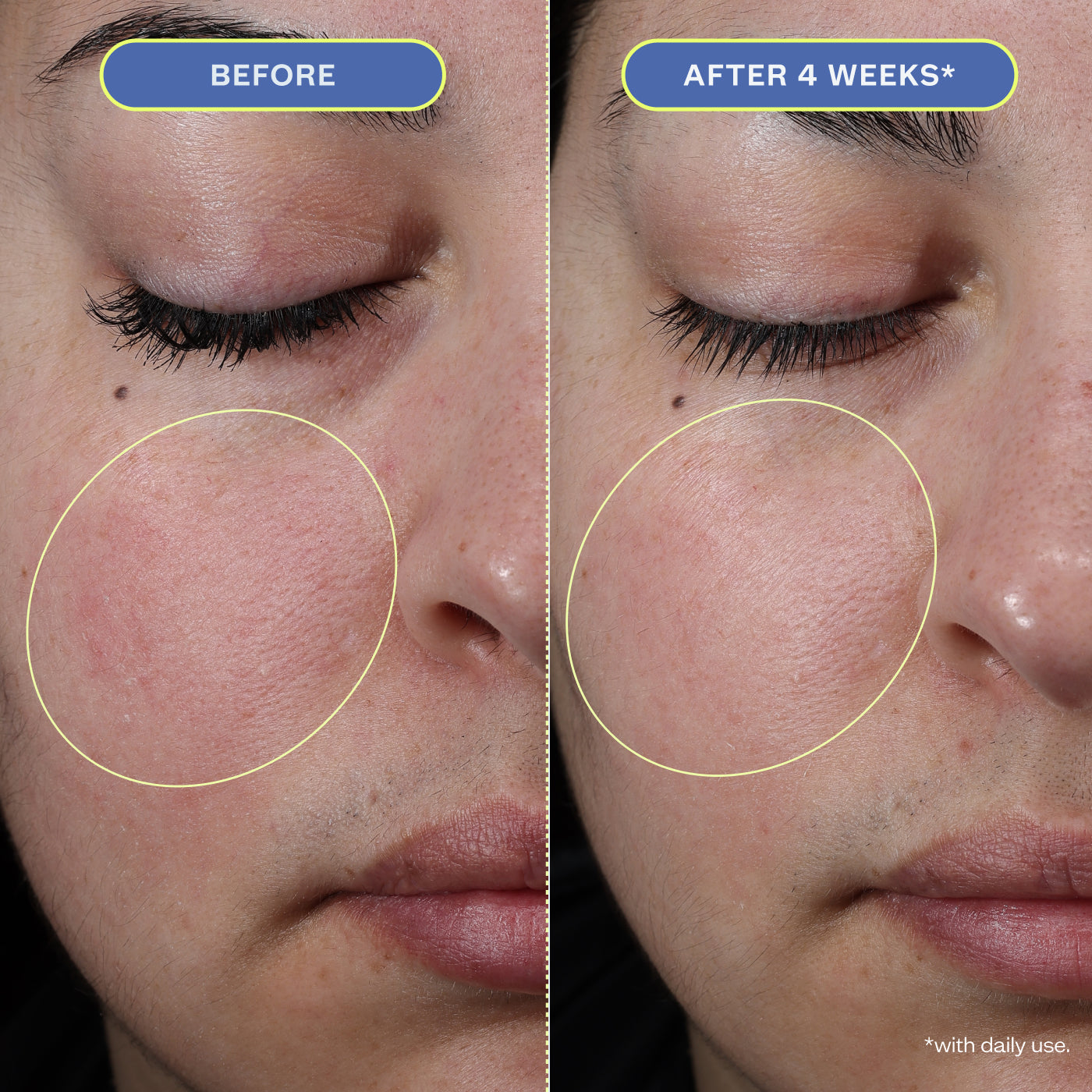 Two close-up photos of a woman's makeup-free face, showing before and after 4 weeks results.