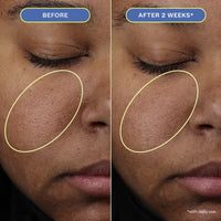 Two close-up photos of a woman's makeup-free face, showing before and after 2 weeks results.