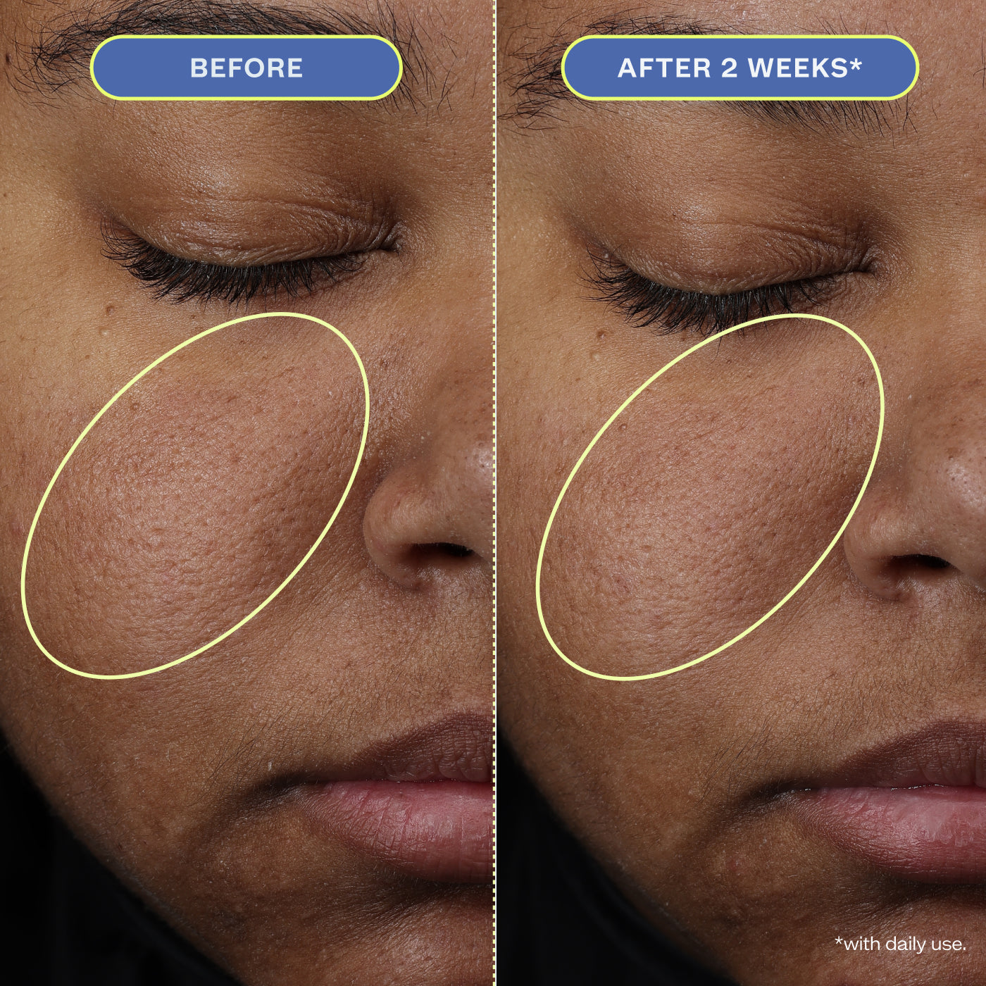 Two close-up photos of a woman's makeup-free face, showing before and after 2 weeks results.