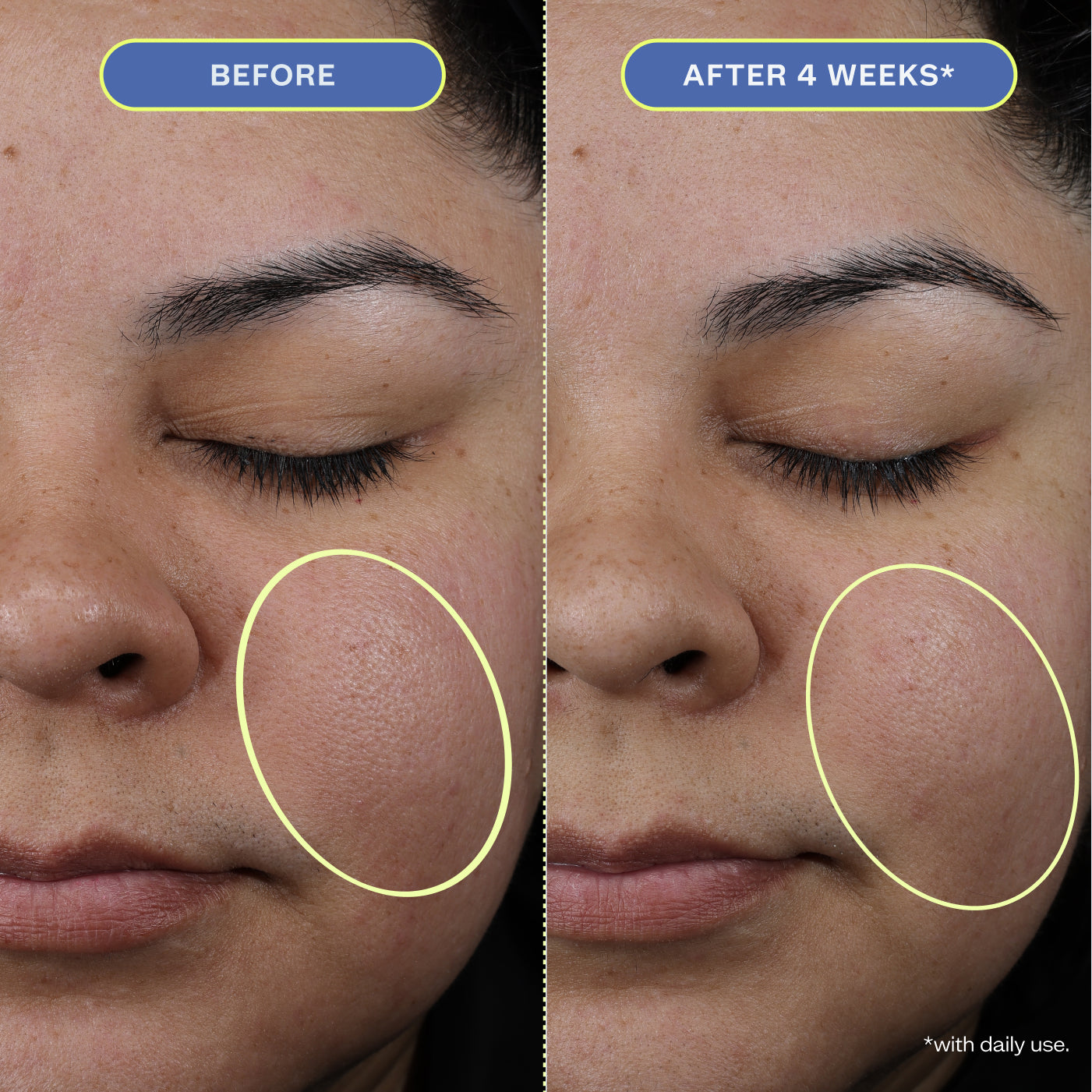 Two close-up photos of a woman's makeup-free face, showing before and after 4 weeks results.