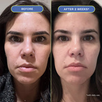 Two close-up photos of a woman's makeup-free face, showing before and after 2 weeks results.