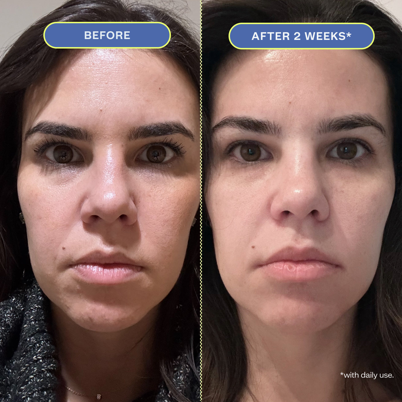 Two close-up photos of a woman's makeup-free face, showing before and after 2 weeks results.