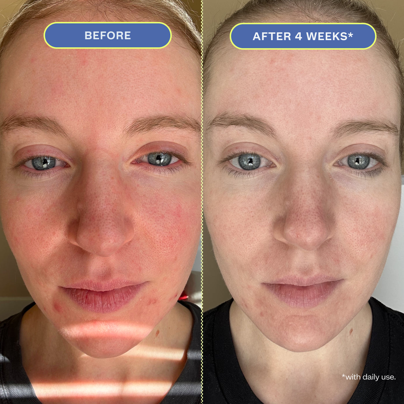 Two close-up photos of a woman's makeup-free face, showing before and after 4 weeks results.