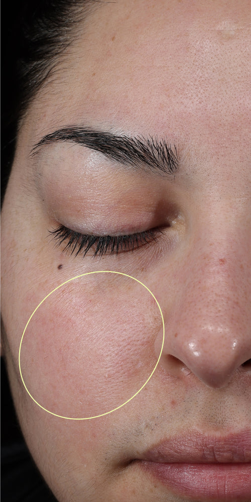 Close-up of a woman's makeup-free face with a circle on her cheek.