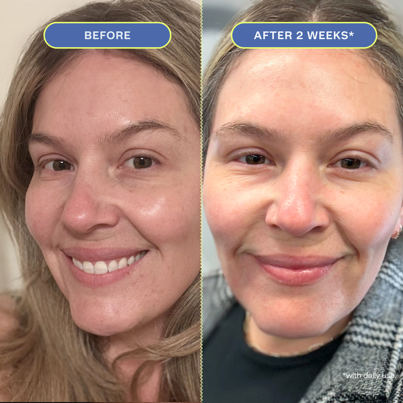 Two close-up photos of a woman's makeup-free face, showing before and after 2 weeks results.