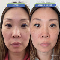 Two close-up photos of a woman's makeup-free face, showing before and after 4 weeks results.