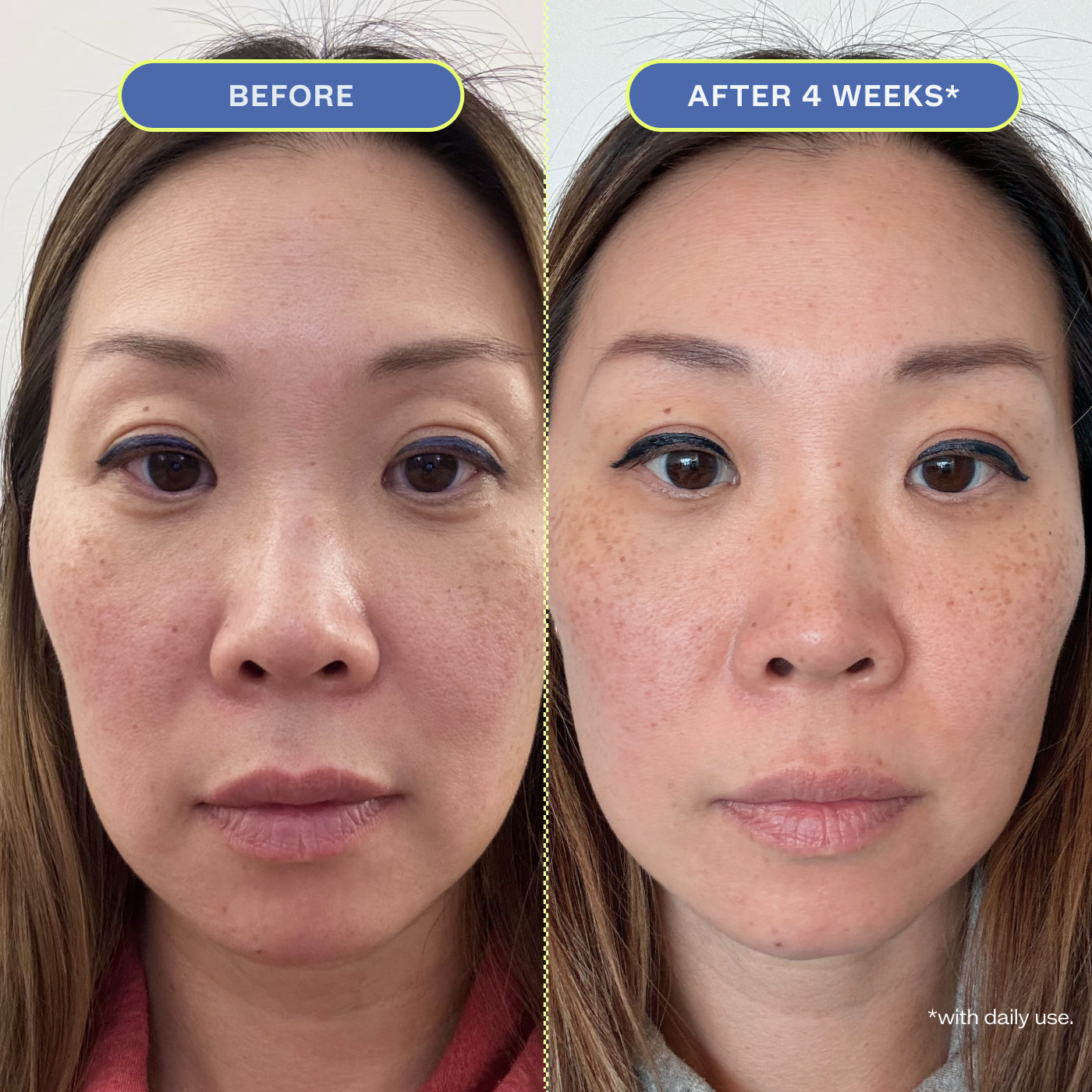 Two close-up photos of a woman's makeup-free face, showing before and after 4 weeks results.