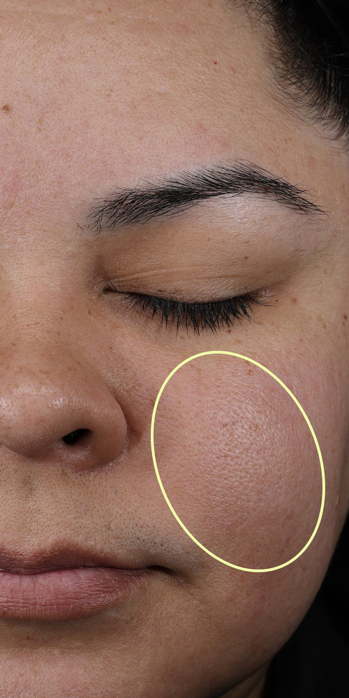 Close-up of a woman's makeup-free face with a circle on her cheek.